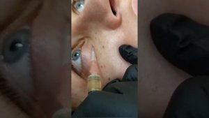 Омоложение переорбитальной зоны. RRS HA Eyes