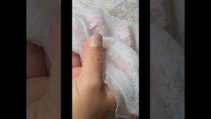 Панариций. В дистальной части ногтя. #вскрытие #помощь #боль #люди #подологбалаково #медицина