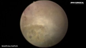 Лазерная энуклеация аденомы простаты (HoLEP). Гольмиевый лазер MultiPulse HoPlus 140W.