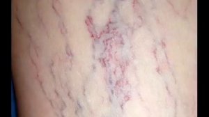 Варикоз на ногах звездочки лечение народными средствами