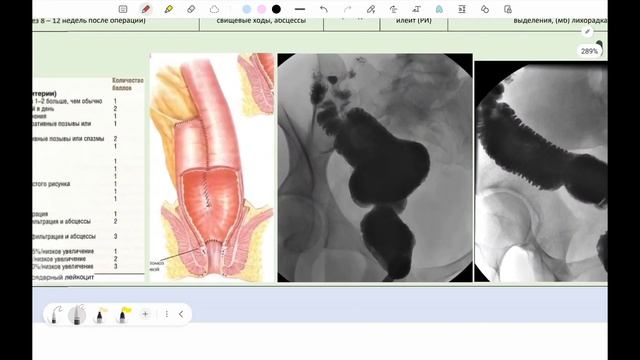 Колэктомия