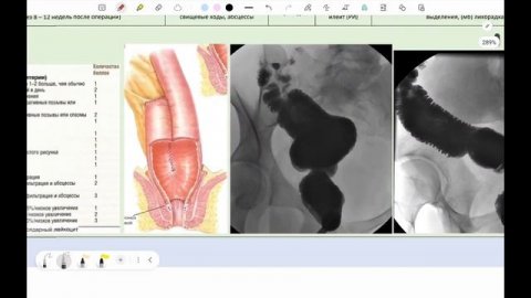 Колэктомия