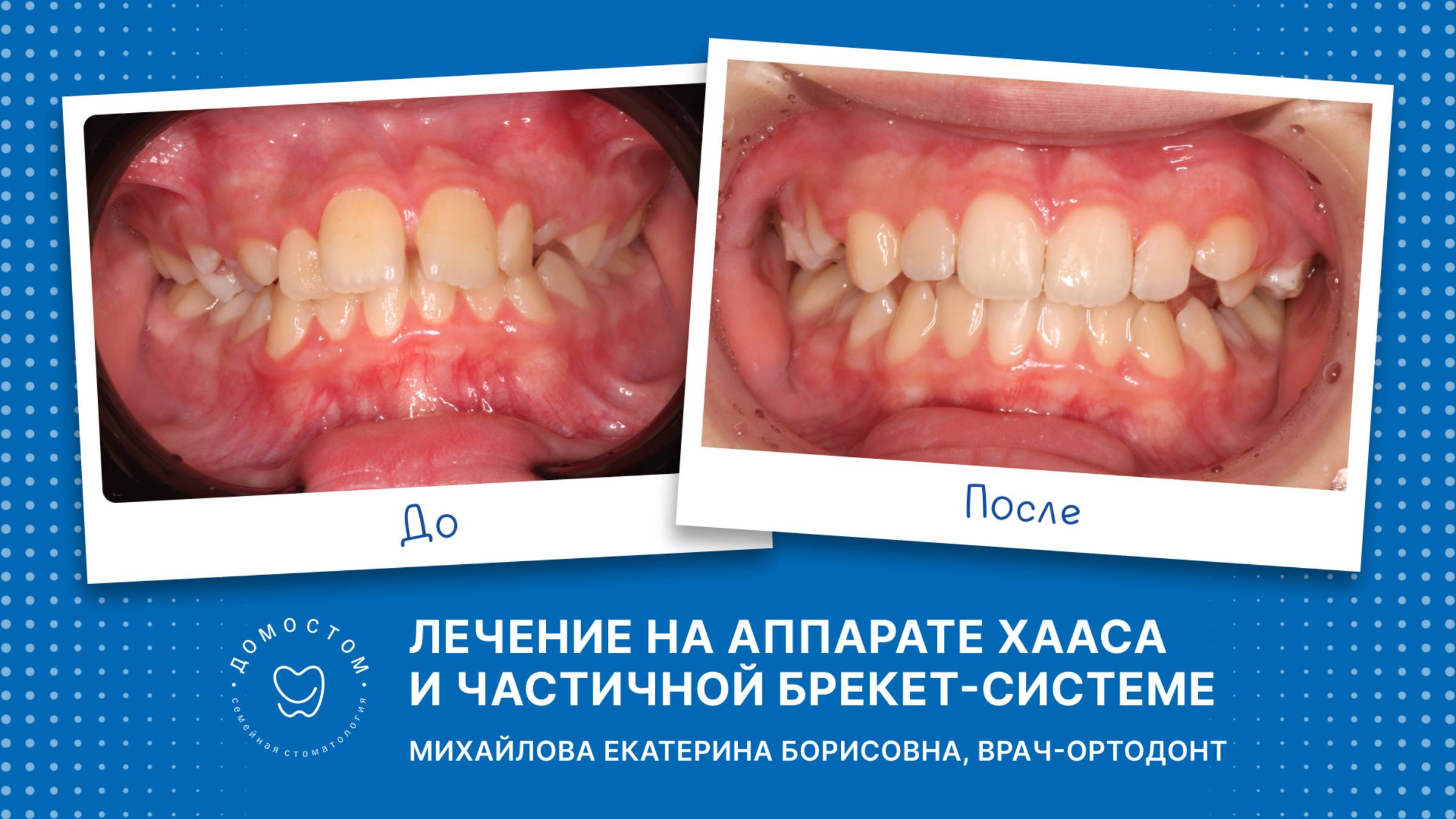 Ортодонтическое лечение на аппарате Хааса и частичной брекет-системе