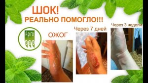 Лечение ожогов Арговасной, Рициниолом и салфеткой Эплан.