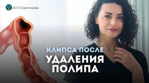 Что такое эндоскопическая клипса? Что такое клипса после удаления полипа?