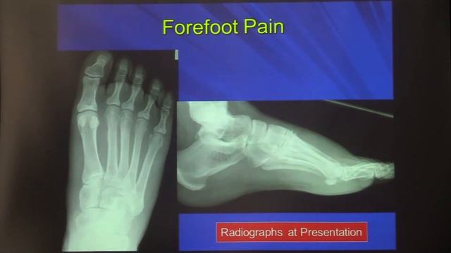 Sports Injuries of the Foot: Multimodality Imaging with Emphasis on MRI - Joel S. Newman