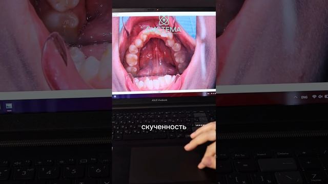 Скученность зубов. До/после лечения на банкетах. Вау результат!