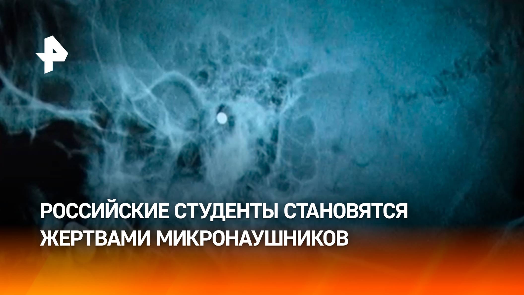 Жертвы микронаушников: студенты из России рискуют здоровьем ради сессий