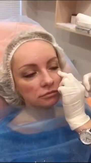 Увеличение скул филером в клинике Аура