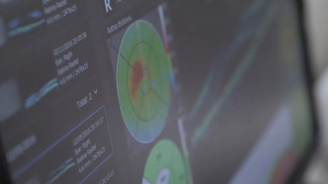 LA ELIMINACIÓN DE DIOPTRÍA CON LASER - Perfect Vision смотреть онлайн