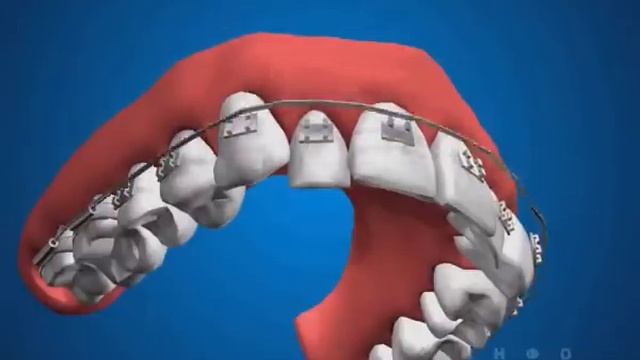 Брекеты, ортодонтия смотреть онлайн
