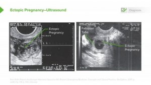 2.06 Ectopic Pregnancy- Diagnosis