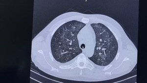 Синдром Гудпасчера