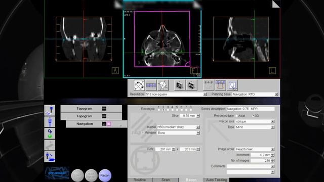 CT Paranasal Sinus Navigation смотреть онлайн