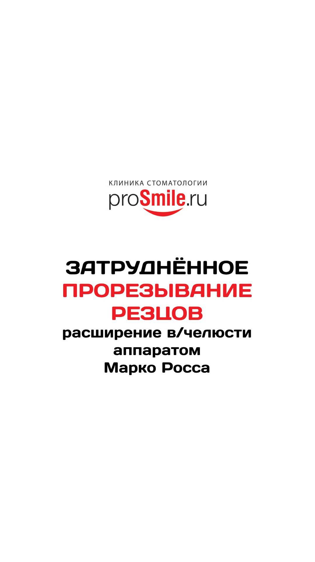 Лечение затруднённого прорезывания аппаратом Марко Росса.