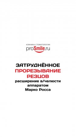 Лечение затруднённого прорезывания аппаратом Марко Росса.
