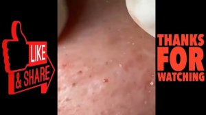 blackheads remove,pimples removal,acne removal treatment,dr pimple popper nose 2021 #16