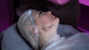 Контурная пластика лица Углы Джоли