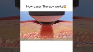 Как работает лазерная терапия/How laser therapy works