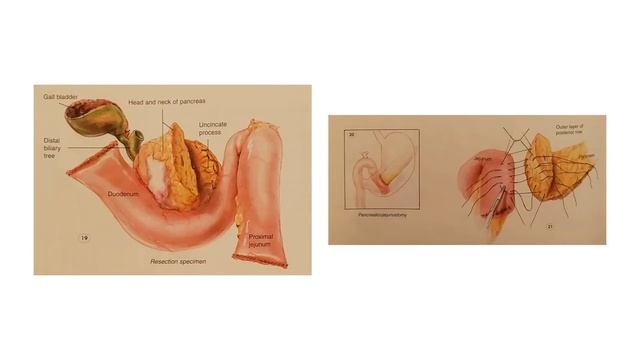 Karim Sarhane MD - Learning Module: Whipple Procedure step by step
