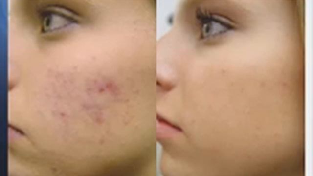 YouTube Acne Treatment with Fotona Laser смотреть онлайн