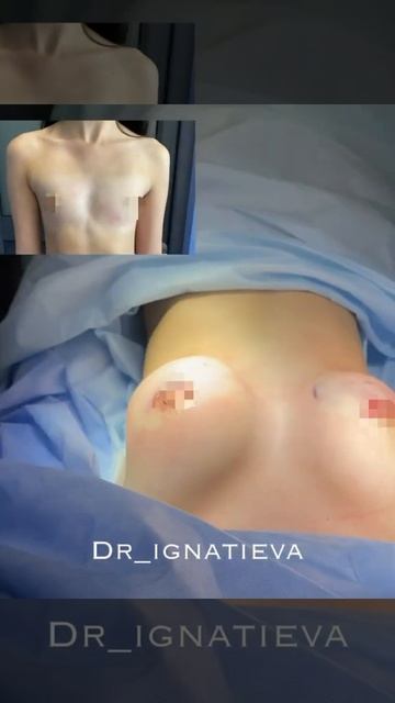 Увеличение груди киев