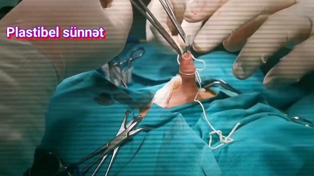 Sünnət ,circumcision смотреть онлайн