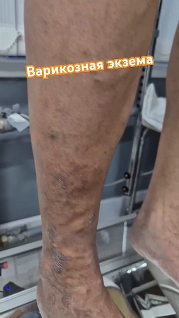 Варикозная экзема. Флеболог Москва.