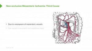 3.07 Mesenteric Ischemia- Epidemiology