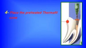 Thermafil - DENTSPLY MAILLEFER [ENDODONTIA]