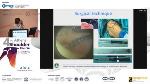 Arthroscopic transosseous repair. Can we avoid implants? - M. F. Saccomanno