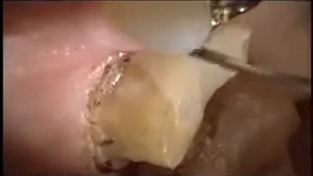 AMD Laser Troughing with Picasso 4 YouTube смотреть онлайн