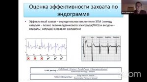 Кардиоресинхронизирующая терапия: предикторы успеха