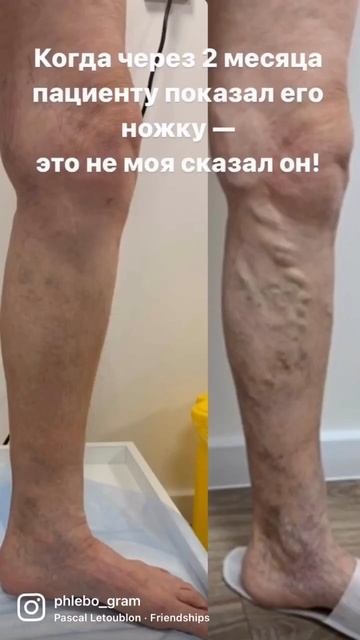Вылечить варикоз лазером за 30 минут.