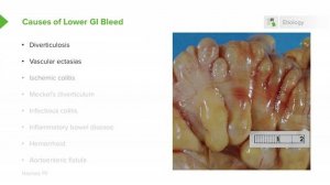 2.10 Gastrointestinal Bleeding (GI Bleed)