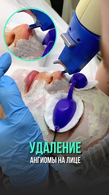 Удаление ангиомы на лице лазером #ангиома #неодимовыйлазер #сосуды #гемангиома #сосудистыезвездочки