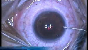 Femto LASIK on Ziemer Z6
