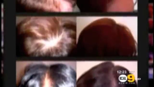 iGrow on KCAL-LA | Advancements in Los Angeles Laser Hair Restoration смотреть онлайн