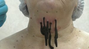 Гирудотерапия + плазмотерапия при коррекции овала лица и мимических морщин. Фрагмент вебинара