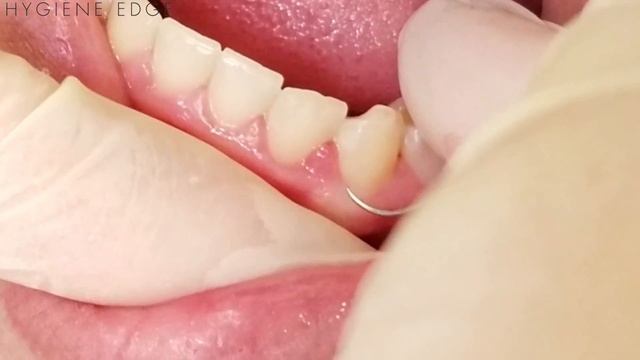 Calculus Detection Tip for the Dental Hygienist смотреть онлайн