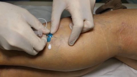 sclerotherapy склеротерапия