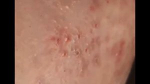 FINDING BLACKHEADS AND EXTRACTING. Выдавливание черных точек