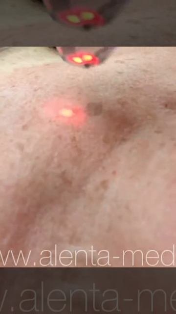 Лазерное омоложение кожи в Алента-мед-фракционный фототермолиз на аппарате Clear&Brilliant (США).