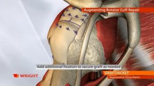 Augment Rotator Cuff Repair with GRAFTJACKET™ Regenerative Tissue Matrix