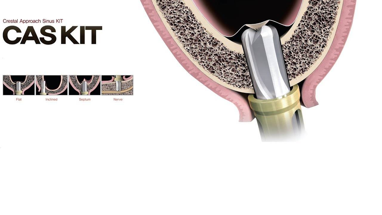 Набор для закрытого синус-лифтинга CAS KIT (характеристики и протокол)