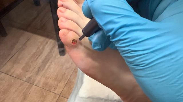 Wart removal with Co2 fractional laser. смотреть онлайн