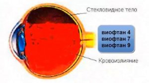 Применение виофтанов при кровоизлиянии в стекловидное тело глаза