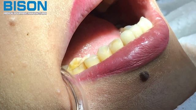 DentalQ Diode Laser Teeth desensitizing Video смотреть онлайн