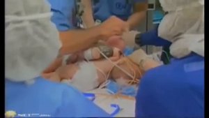 Родители отказались от детей, когда узнали, что они сиамские близнецы  Жизнь детей спустя 16 лет