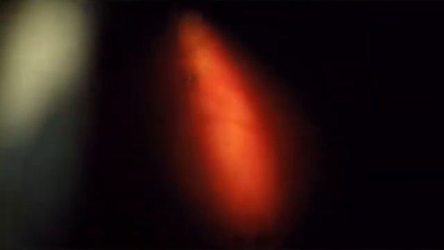 13006 2018 02 15 os laser1 toxoplasmose and floaters смотреть онлайн